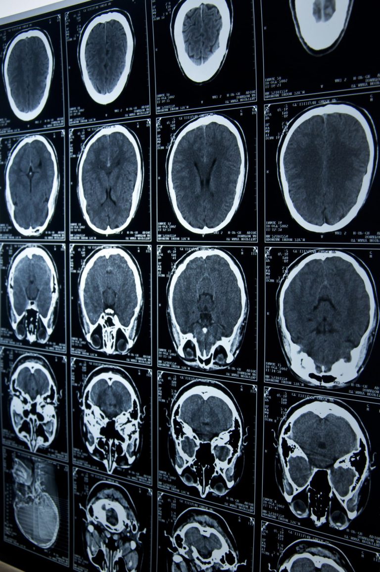 brain injury lawyer Miami FL