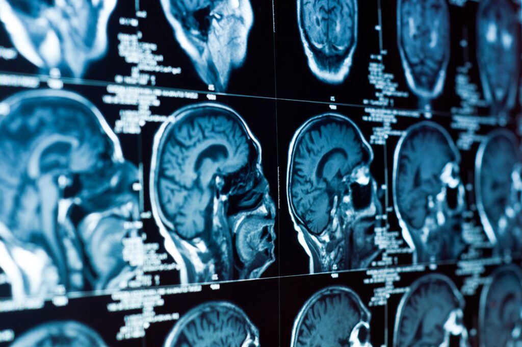 brain injury lawyer in Fort Lauderdale, Florida