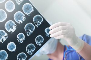 Orlando, FL Brain Injury Lawyer